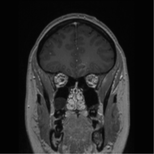 Cerebral cavernoma and development venous anomaly (Radiopaedia 37603-39482 Coronal T1 C+ 71).png