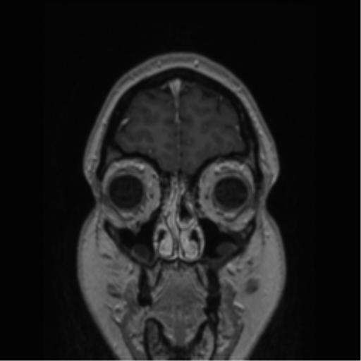 Cerebral cavernoma and development venous anomaly (Radiopaedia 37603-39482 Coronal T1 C+ 82).png