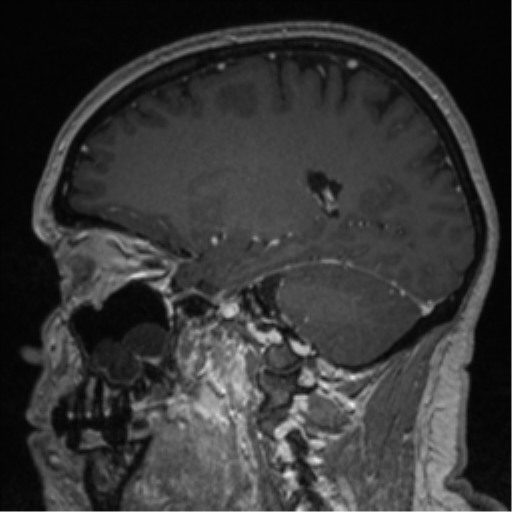 Cerebral cavernoma and development venous anomaly (Radiopaedia 37603-39482 Sagittal T1 C+ 60).png