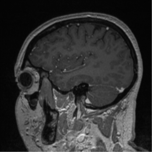 Cerebral cavernoma and development venous anomaly (Radiopaedia 37603-39482 Sagittal T1 C+ 71).png