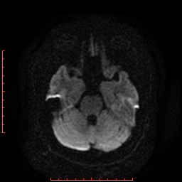 File:Cerebral cavernous malformation (Radiopaedia 26177-26306 Axial DWI 8).jpg