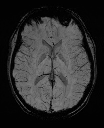 Cerebral cavernous venous malformation (Radiopaedia 70008-80021 Axial SWI 36).jpg