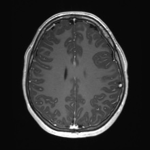 Cerebral cavernous venous malformation (Radiopaedia 70008-80021 Axial T1 C+ 58).jpg