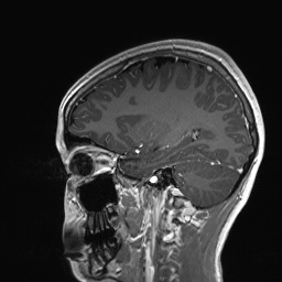 Cerebral cavernous venous malformation (Radiopaedia 70008-80021 Sagittal T1 C+ 23).jpg