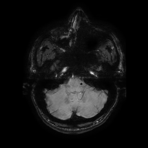Cerebral cavernous venous malformation (Zabramski type II) (Radiopaedia 85511-101198 Axial SWI 29).jpg