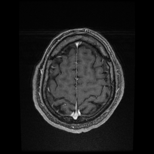Cerebral cavernous venous malformation (Zabramski type II) (Radiopaedia 85511-101198 Axial T1 C+ fat sat 19).jpg