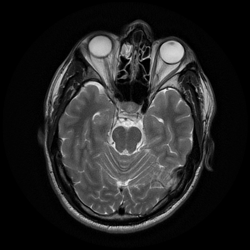 File:Cerebral cavernous venous malformation (Zabramski type II) (Radiopaedia 85511-101198 Axial T2 12).jpg