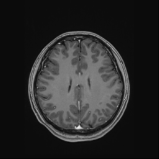 File:Cerebral cavernous venous malformations (Radiopaedia 48117-52946 Axial T1 C+ 41).png