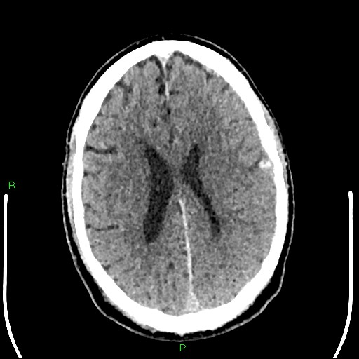 Cerebral contusions (Radiopaedia 33868-35039 Axial non-contrast 137).jpg