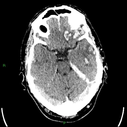 Cerebral contusions (Radiopaedia 33868-35039 Axial non-contrast 70).jpg