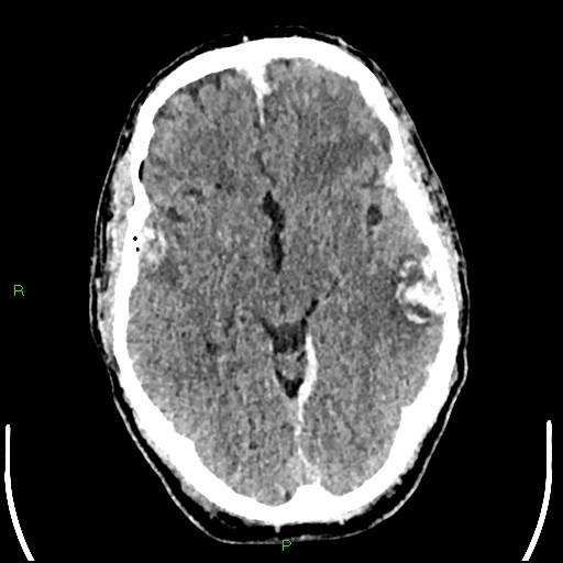 Cerebral contusions (Radiopaedia 33868-35039 Axial non-contrast 91).jpg