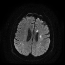 Cerebral embolic infarcts (embolic shower) (Radiopaedia 49837-55108 Axial DWI 64).jpg