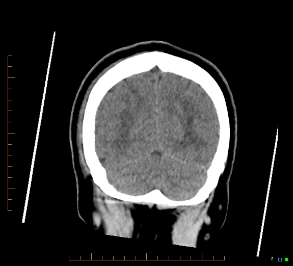 Cerebral fat embolism (Radiopaedia 85521-101220 Coronal non-contrast 51).jpg