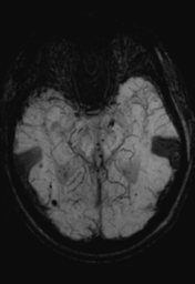 File:Cerebral hemorrhagic contusions- temporal evolution (Radiopaedia 40224-42757 Axial SWI 13).png
