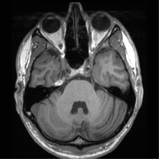 File:Cerebral hemorrhagic contusions- temporal evolution (Radiopaedia 40224-42757 Axial T1 22).png