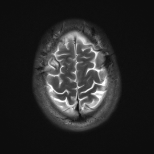 File:Cerebral hemorrhagic contusions- temporal evolution (Radiopaedia 40224-42757 Axial T2 20).png