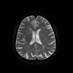 Cerebral metastases - melanoma (Radiopaedia 80972-94522 Axial DWI 83).jpg