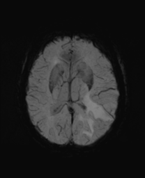 File:Cerebral metastasis (Radiopaedia 46744-51248 Axial SWI 18).png