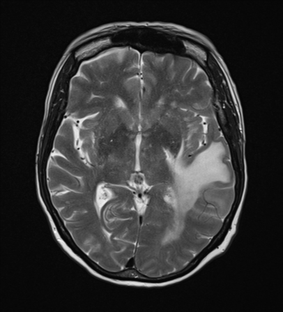 File:Cerebral metastasis (Radiopaedia 46744-51248 Axial T2 13).png