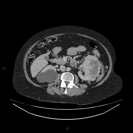 Cerebral metastasis from renal cell carcinoma (Radiopaedia 82306-96378 A 80).jpg