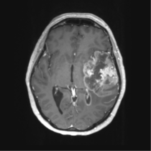 Cerebral metastasis mimicking glioblastoma (Radiopaedia 69155-78937 Axial T1 C+ 30).png