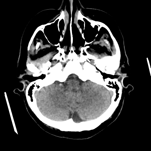 Cerebral metastasis to basal ganglia (Radiopaedia 81568-95412 Axial non-contrast 17).png