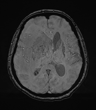 File:Cerebral metastasis to basal ganglia (Radiopaedia 81568-95413 Axial SWI 47).png