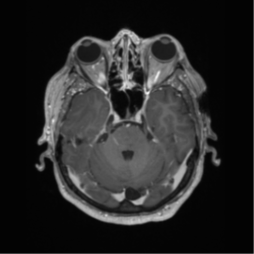 Cerebral metastasis to basal ganglia (Radiopaedia 81568-95413 Axial T1 C+ 20).png