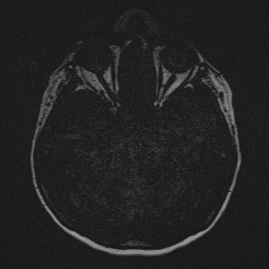 Cerebral ring enhancing lesions - cerebral metastases (Radiopaedia 44922-48817 F 1).jpg