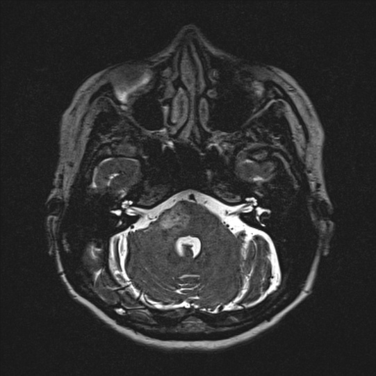 Cerebral ring enhancing lesions - cerebral metastases (Radiopaedia 44922-48817 F 34).jpg