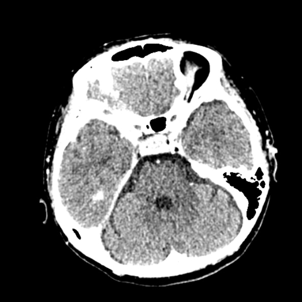 Cerebral ring enhancing lesions - cerebral metastases (Radiopaedia 44922-48818 B 94).jpg