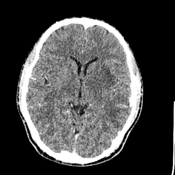 Cerebral toxoplasmosis (Radiopaedia 53993-60131 Axial C+ delayed 35).jpg