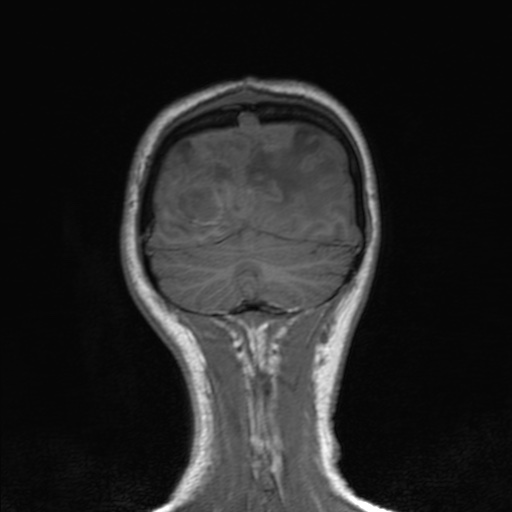 Cerebral tuberculosis with dural sinus invasion (Radiopaedia 60353-68090 Coronal T1 154).jpg