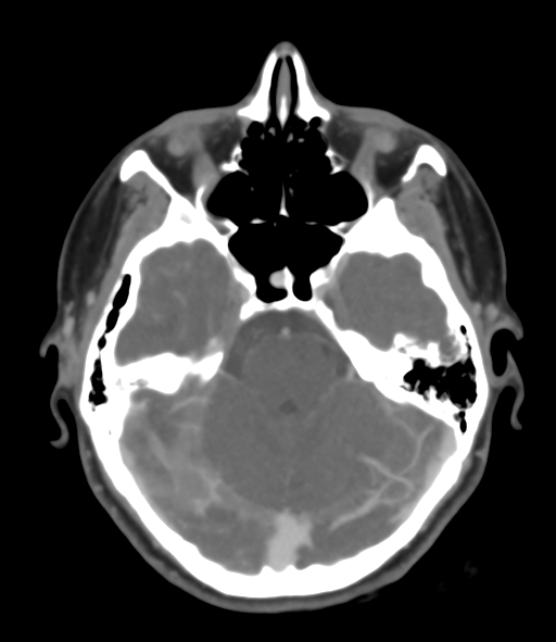 Cerebral venous hemorrhagic infarction (Radiopaedia 38461-40550 Axial MIP VENOGRAM 17).png