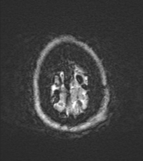 Cerebral venous infarct (Radiopaedia 53627-59685 Axial SWI 54).jpg