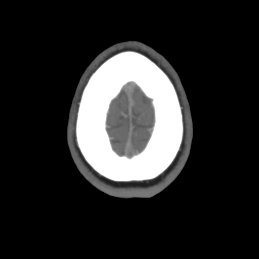 File:Cerebral venous infarct related to dural venous sinus thromboses (Radiopaedia 35292-36804 Axial C+ delayed 46).png