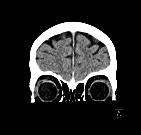 Cerebral venous infarction with hemorrhage (Radiopaedia 65343-74381 Coronal non-contrast 6).jpg