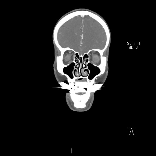 File:Cerebral venous infarction with hemorrhage (Radiopaedia 65343-74396 B 65).jpg