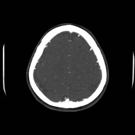 Cerebral venous sinus thrombosis (Radiopaedia 40619-43227 A 189).jpg
