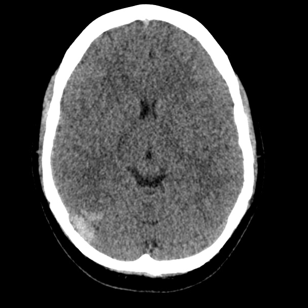 Cerebral venous sinus thrombosis (Radiopaedia 59224-66551 Axial non-contrast 9).jpg