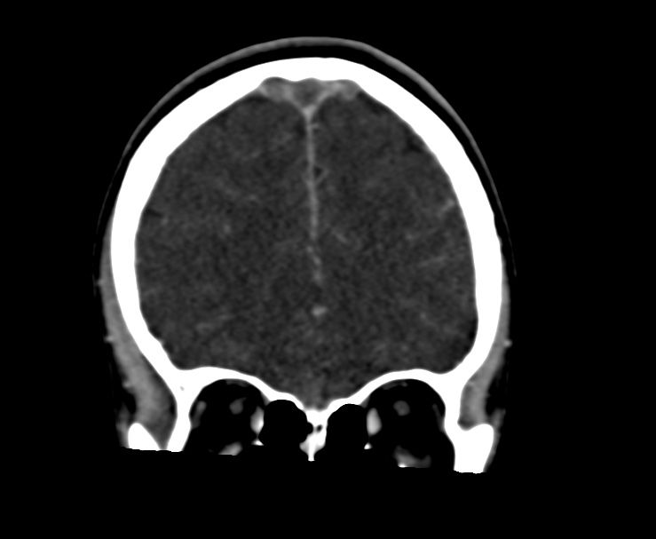 Cerebral venous sinus thrombosis (Radiopaedia 59224-66646 Coronal C+ delayed 17).jpg