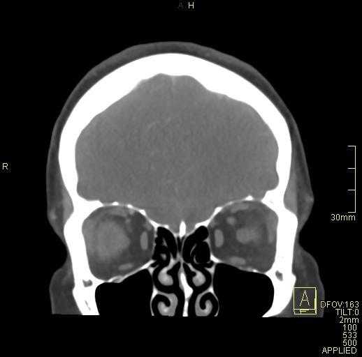 Cerebral venous sinus thrombosis (Radiopaedia 91329-108965 Coronal venogram 19).jpg