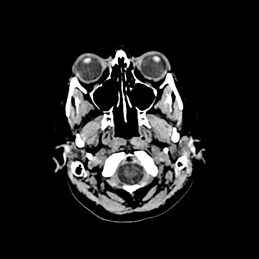 Cerebral venous throbmosis - hemorrhagic venous infarction (Radiopaedia 87318-103613 Axial non-contrast 9).jpg