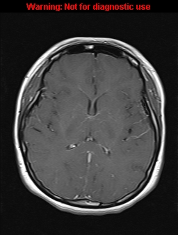 File:Cerebral venous thrombosis (Radiopaedia 37224-39208 Axial T1 C+ 12).jpg