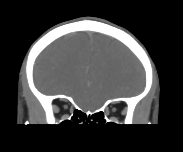 Cerebral venous thrombosis (Radiopaedia 38392-40467 Coronal CTA-Venogram 17).png