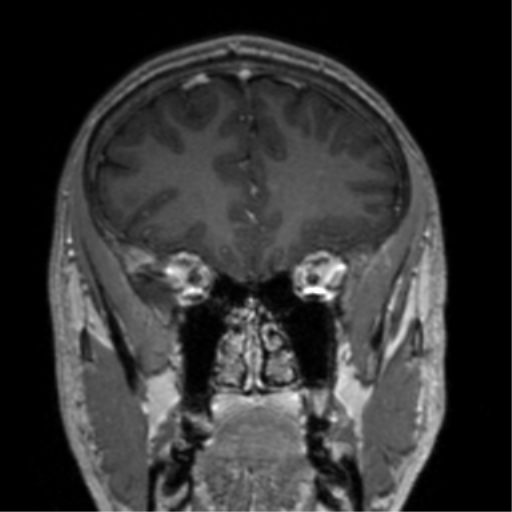 Cerebral venous thrombosis (Radiopaedia 38392-40469 Coronal T1 C+ 67).png