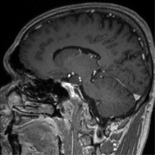 File:Cerebral venous thrombosis (Radiopaedia 38392-40469 Sagittal T1 C+ 39).png