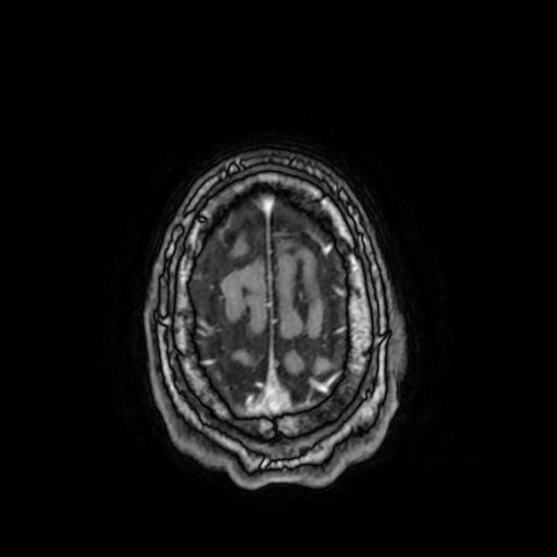 File:Cerebral venous thrombosis with secondary intracranial hypertension (Radiopaedia 89842-106957 Axial T1 C+ 153).jpg