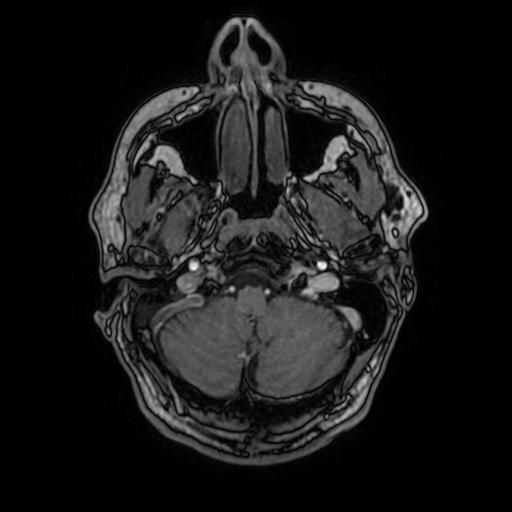 File:Cerebral venous thrombosis with secondary intracranial hypertension (Radiopaedia 89842-106957 Axial T1 C+ 42).jpg