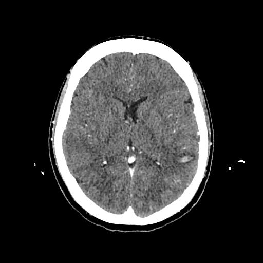 Cerebral venous thrombosis with venous hemorrhagic infarct (Radiopaedia 90354-107660 Axial with contrast 90).jpg